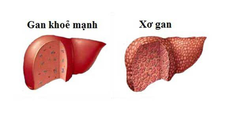Gan bị xơ